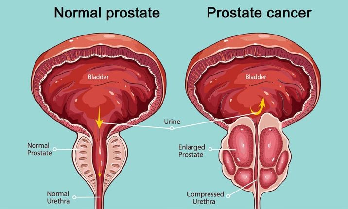 Penyebab kanker prostat