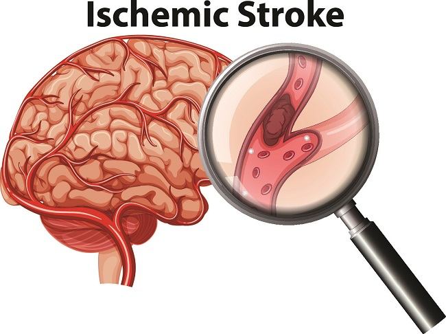 stroke allodok